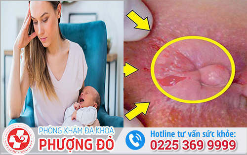 Dấu hiệu bị trĩ sau sinh