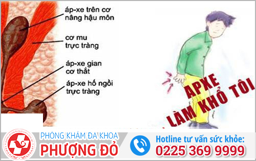 Nguyên nhân gây áp xe hậu môn