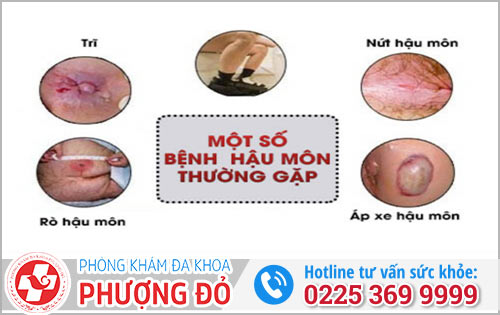 Bệnh Hậu Môn Thường Gặp