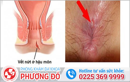 Bệnh Nứt Hậu Môn Là Gì?