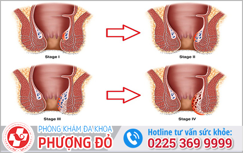 Bệnh Trĩ Có Tự Khỏi Không?