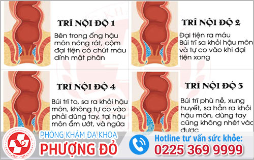 Dấu Hiệu Nhận Biết Sớm Bệnh Trĩ Nội