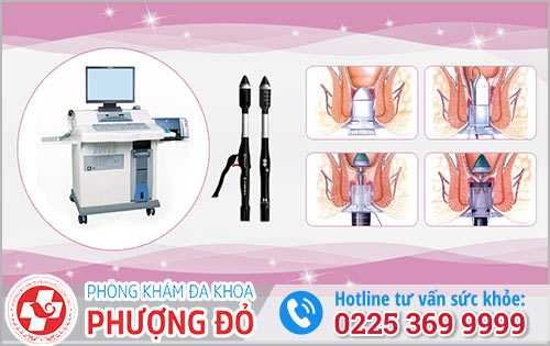 Các Phương Pháp Hỗ Trợ Điều Trị Trĩ