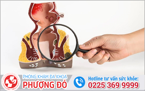 Dấu hiệu bị trĩ ngoại độ 1, độ 2