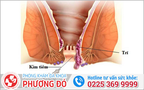 Chữa bệnh trĩ hiệu quả - ít biến chứng với phương pháp chích xơ