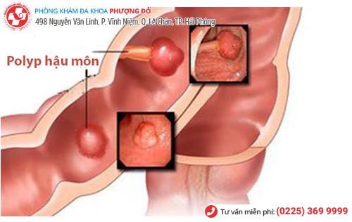 biểu hiện polyp hậu môn