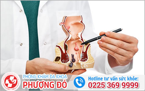 Cách Chữa Lòi Dom Hiệu Quả Hiện Nay