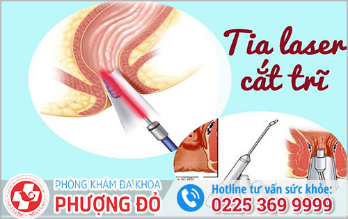 Mổ trĩ bằng Laser