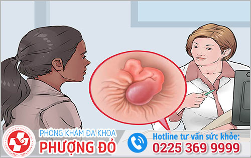 Địa chỉ điều trị bệnh trĩ uy tín, hiệu quả, hạn chế tái phát