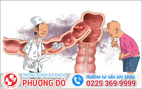 Cách hỗ trợ điều trị bệnh polyp hậu môn hiệu quả