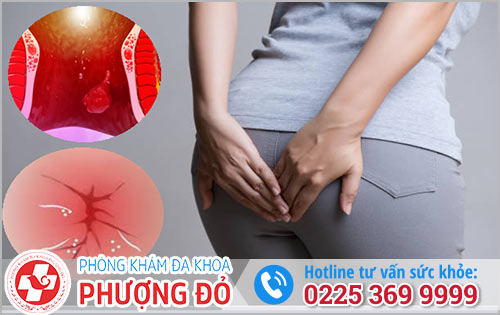 Sưng, đau hậu môn do mắc bệnh Polyp hậu môn