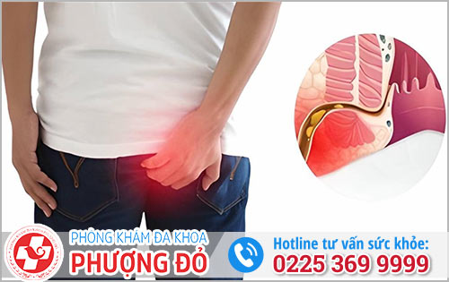 Sưng Đít Gây Khó Khăn Trong Sinh Hoạt Thì Phải Làm Sao Hết?