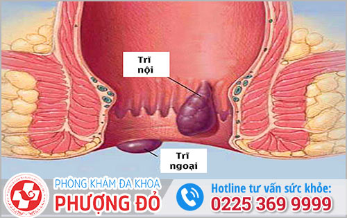 Thế Nào Là Bệnh Trĩ?