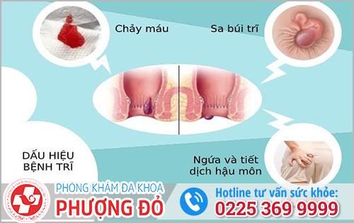 Cách Nhận Biết Bệnh Trĩ