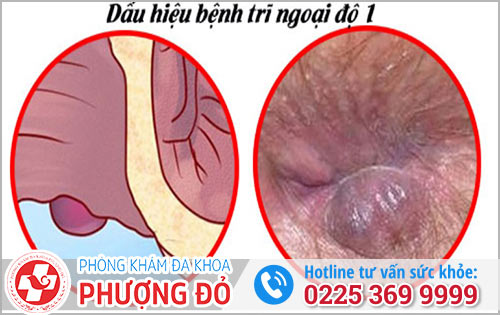 Dấu Hiệu Bệnh Trĩ Ngoại