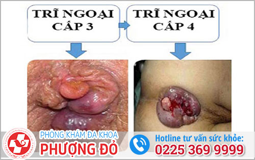 Biến Chứng Nguy Hiểm Của Bệnh Trĩ Ngoại Chớ Nên Xem Thường