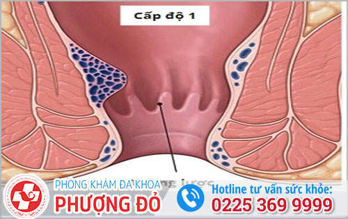 Phương pháp điều trị bệnh trĩ cấp độ 1 