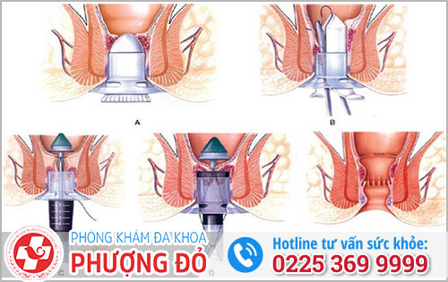 Các phương pháp phẫu thuật trĩ cấp độ 3