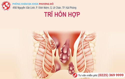 biểu hiện trĩ hỗn hợp