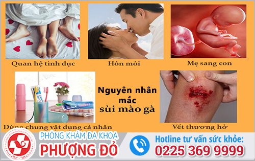 Nguyên nhân gây sùi mào gà