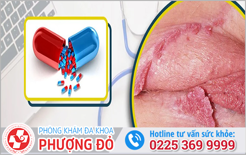 Thuốc điều trị sùi mào gà
