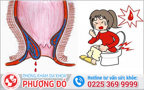 Cảnh báo: đại tiện ra máu tươi là dấu hiệu những bệnh lý nguy hiểm