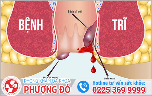 Nhận biết cấp độ bệnh trĩ