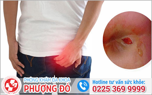 Nhiễm trùng hậu môn gây lở loét nguy hiểm