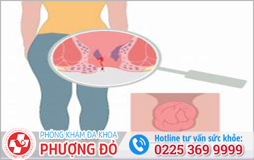 Bệnh trĩ gây ra nhiều biến chứng nguy hiểm cho người bệnh