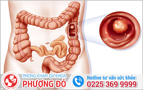 Polyp trưc tràng là gì?