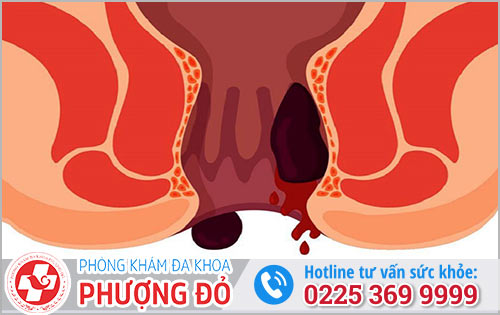 Nguyên Nhân Quan Hệ Hậu Môn Ra Máu