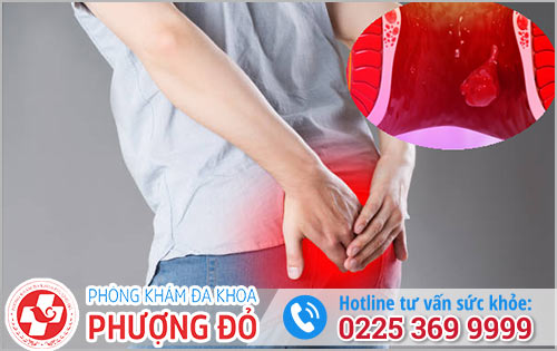 Sa Búi Trĩ Ngoại Có Nguy Hiểm Không?