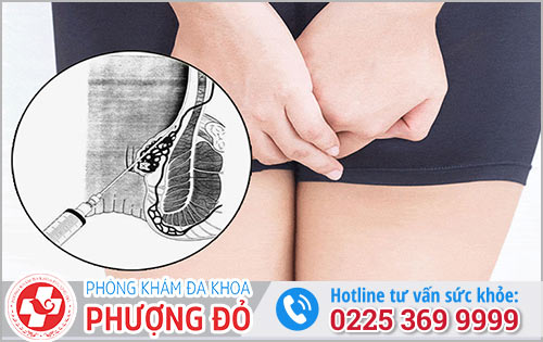 Tim hiểu về phương pháp tiêm xơ búi trĩ