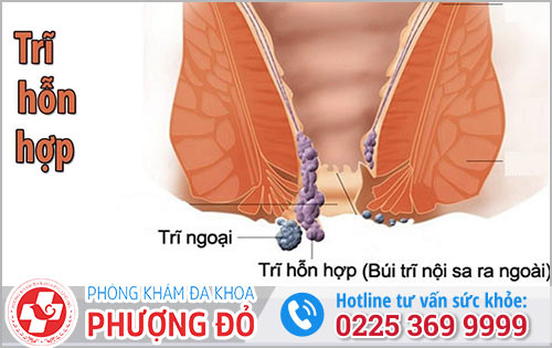 Trĩ hỗn hợp là gì?